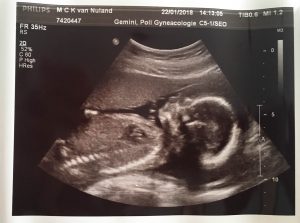 Baby 2 20 weken echo